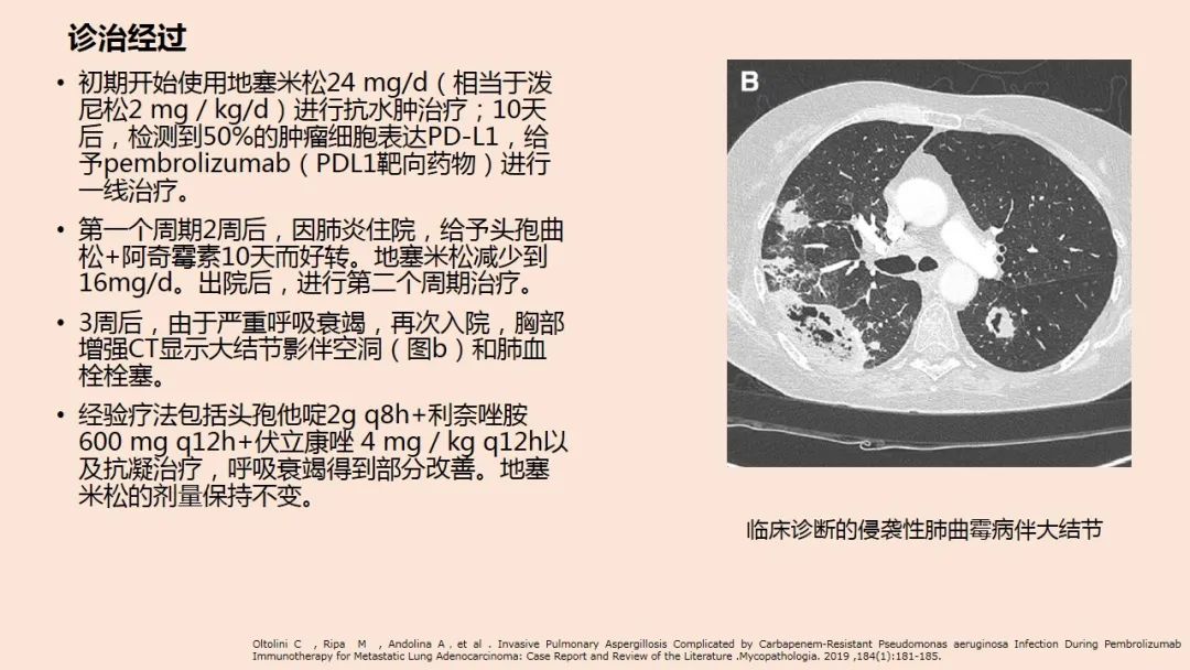 大爷节前大扫除后感染肺曲霉病，警惕居家清洁与健康防护