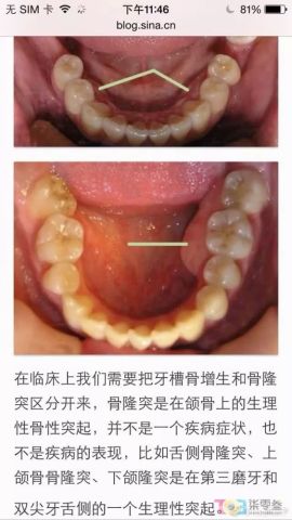 女子拔牙后第三天口腔惊现腐臭味，背后真相令人揪心！深度解析事件始末。